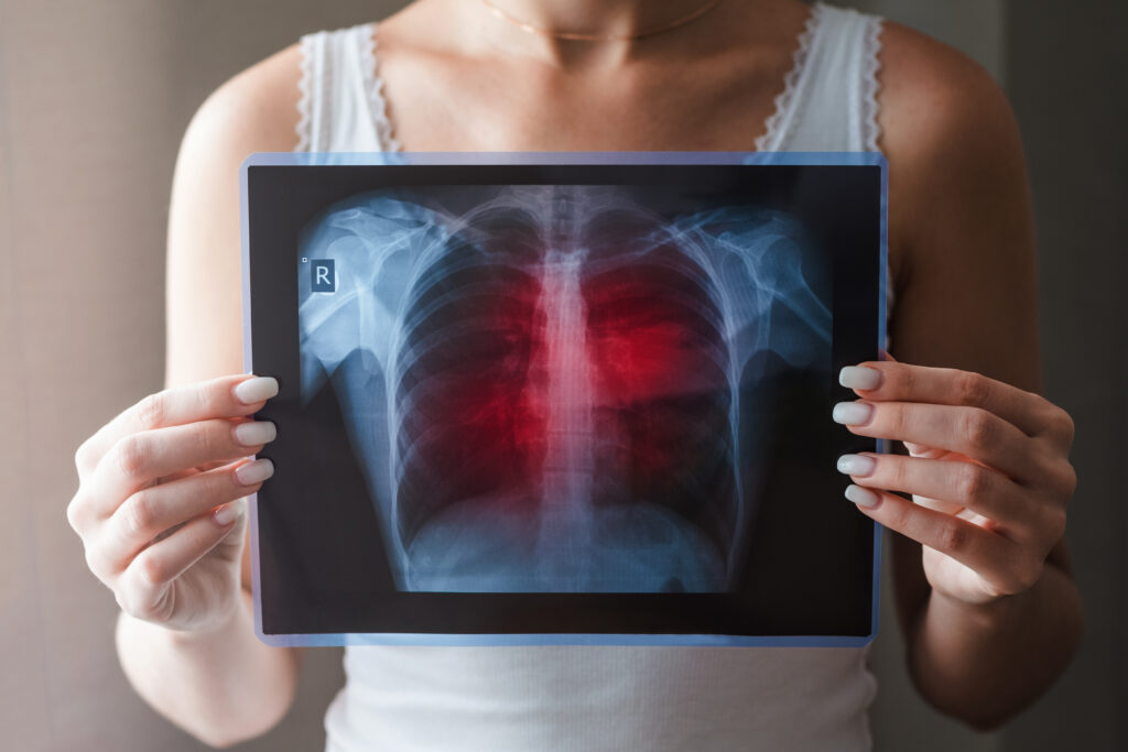Patient holding radiography lung scan that indicates lung cancer - Mesothelioma cancer lawyer